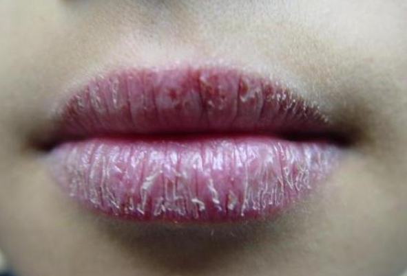 هل جفاف الشفاه يدل على مشكلة صحية خطيرة؟ متى يجب القلق؟